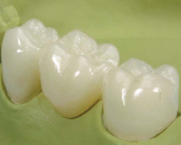 3M拉瓦全瓷牙,高端全瓷牙冠,牙齿修复