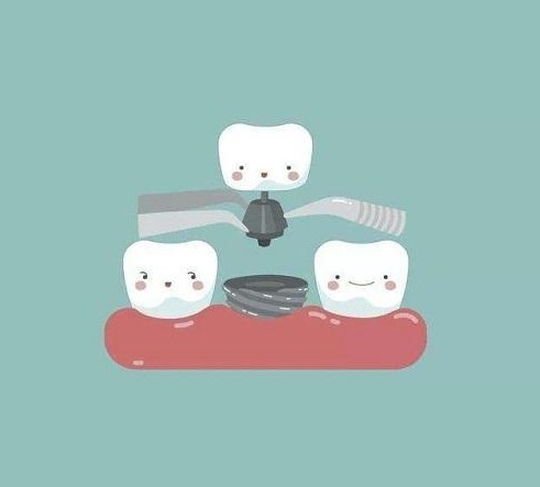 韩国登腾种植牙,种植牙手术,种植牙后期稳定性